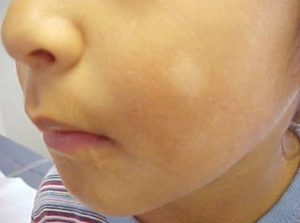 استشاري يكشف أسباب البقع البيضاء على بشرة الأطفال.. والفرق بين مرض النخالة والبهاق 4