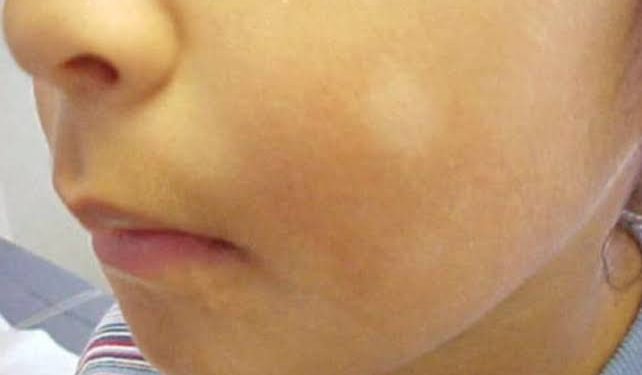 استشاري يكشف أسباب البقع البيضاء على بشرة الأطفال.. والفرق بين مرض النخالة والبهاق 1